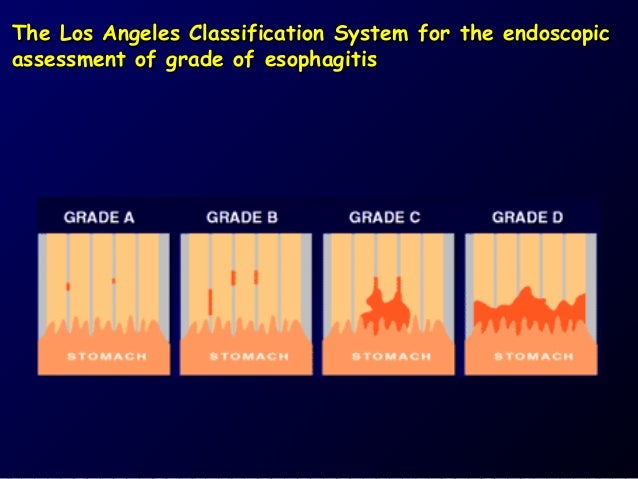 Los Angeles Classification Of Esophagitis NSOGM Los Angeles Classification Of Esophagitis NSOGM