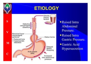 S
V
ETIOLOGYETIOLOGY
•Raised Intra
Abdominal
Pressure.V
M
C
Pressure.
•Raised Intra
Gastric Pressure.
•Gastric Acid
Hypersecretion
 