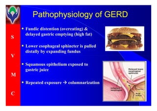 S
V
PathophysiologyPathophysiology of GERDof GERD
• Fundic distention (overeating) &
delayed gastric emptying (high fat)
• Lower esophageal sphincter is pulled
distally by expanding fundus
V
M
C
• Squamous epithelium exposed to
gastric juice
• Repeated exposure columnarization
 