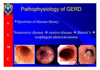 S
V
PathophysiologyPathophysiology of GERDof GERD
•Spectrum of disease theory:
Nonerosive disease erosive disease Barrett’s
esophageal adenocarcinoma
V
M
C
esophageal adenocarcinoma
 