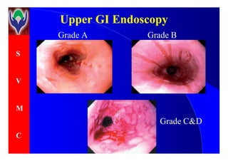 S
V
Upper GI EndoscopyUpper GI Endoscopy
Grade BGrade A
V
M
C
Grade C&D
 