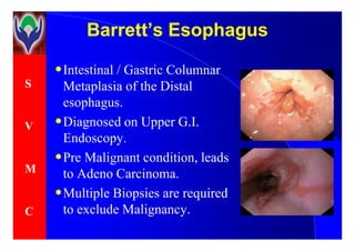 S
V
Barrett’s EsophagusBarrett’s Esophagus
•Intestinal / Gastric Columnar
Metaplasia of the Distal
esophagus.
•Diagnosed on Upper G.I.V
M
C
•Diagnosed on Upper G.I.
Endoscopy.
•Pre Malignant condition, leads
to Adeno Carcinoma.
•Multiple Biopsies are required
to exclude Malignancy.
 