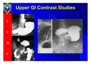 S
V
Upper GI Contrast StudiesUpper GI Contrast Studies
V
M
C
 