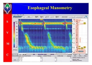 S
V
EsophagealEsophageal ManometryManometry
V
M
C
 