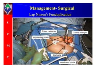 S
V
ManagementManagement-- SurgicalSurgical
Lap Nissen’s Fundoplication
V
M
C
 