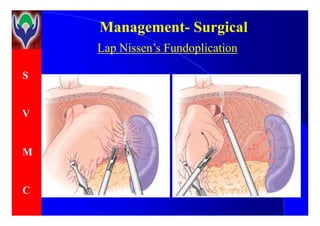 S
V
ManagementManagement-- SurgicalSurgical
Lap Nissen’s Fundoplication
V
M
C
 
