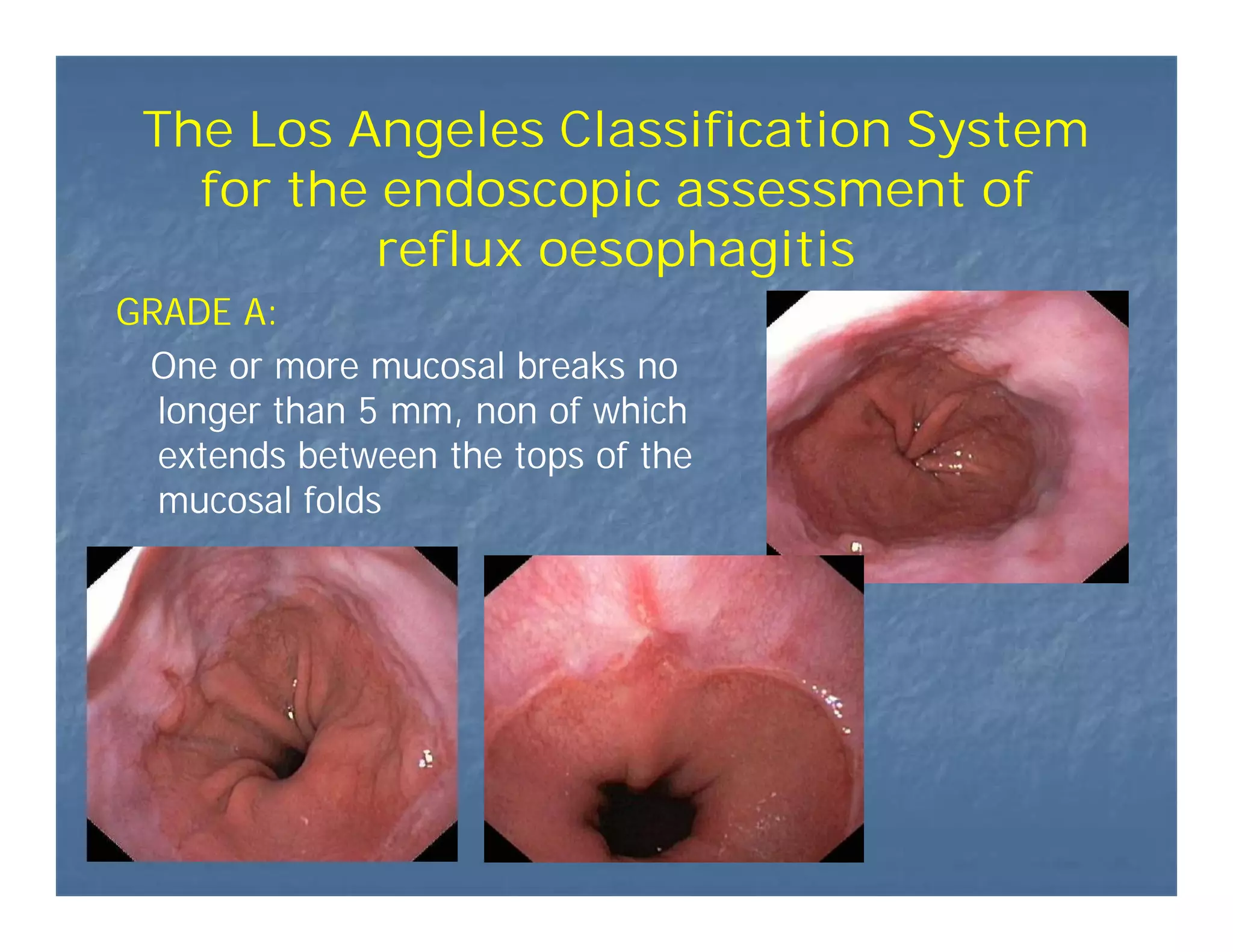 gastroesophageal-reflux-disease-pdf