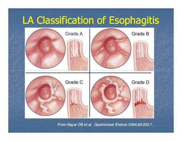 la grade a relux esophagitis la grade a relux esophagitis