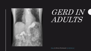 GERD IN
ADULTS
Photo by Steven Fruitsmaak / CC BY-SA 3.0
 