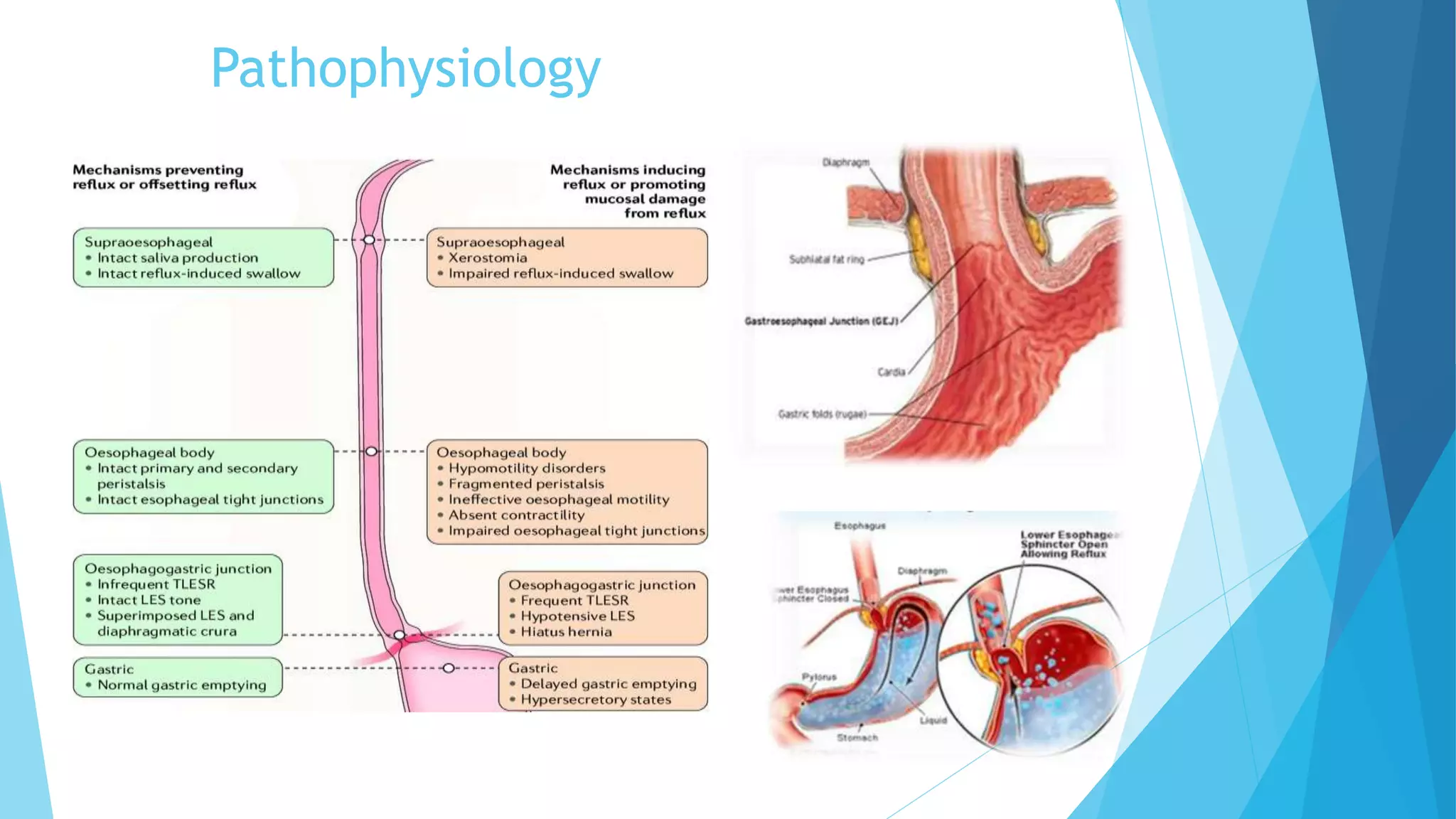 Gastroesophageal Reflux Disease | PPT | Free Download