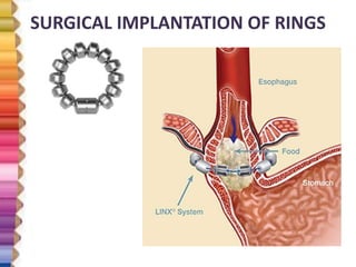 Intestine Rings GASTRO ESOPHAGEAL REFLUX DISEASE | PPTX