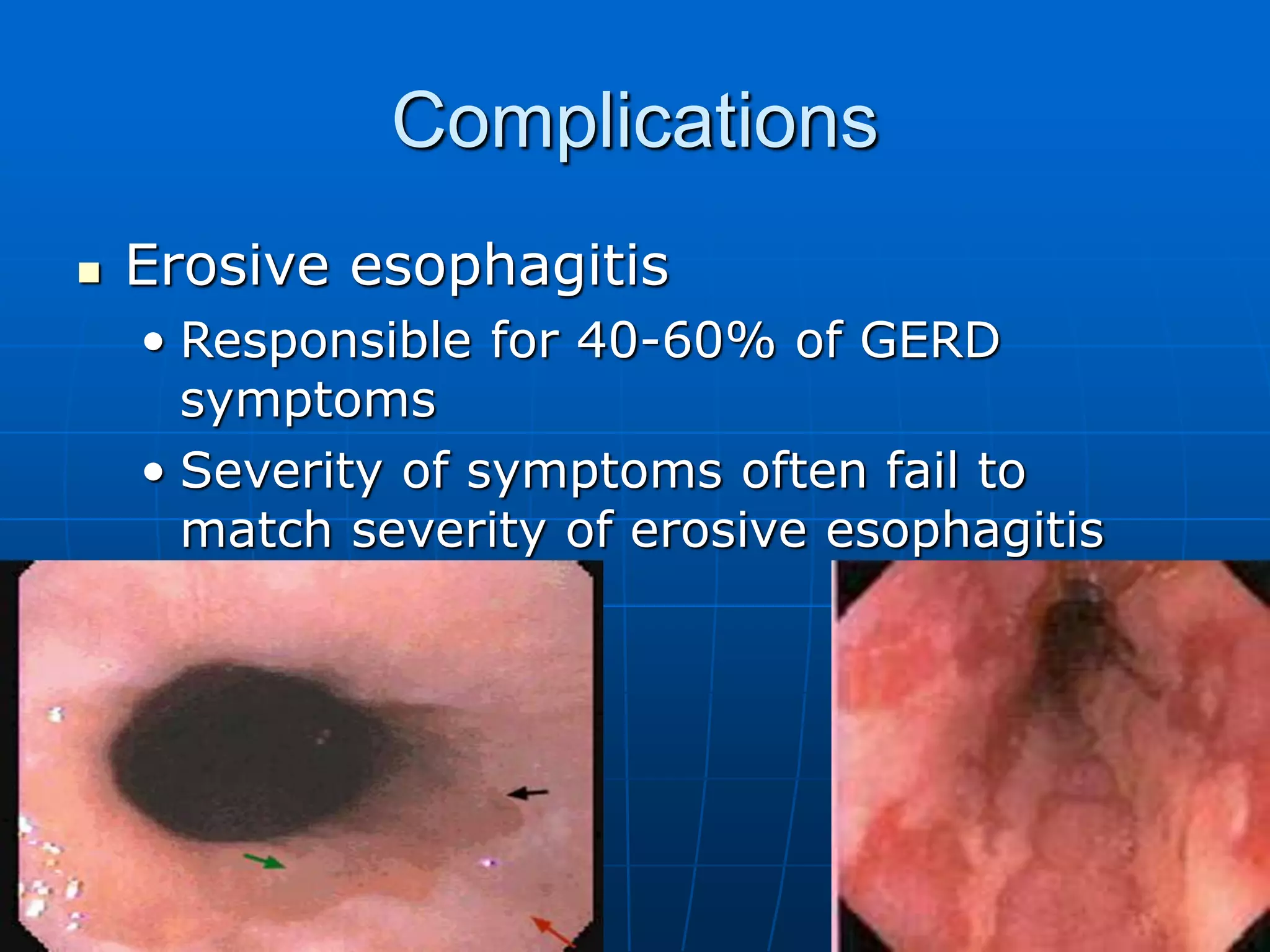 Gastro Esophageal Reflux Disease | PPT