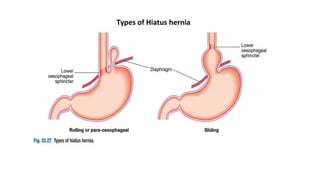 Types of Hiatus hernia
 