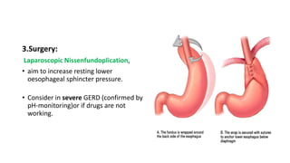 3.Surgery:
Laparoscopic Nissenfundoplication,
• aim to increase resting lower
oesophageal sphincter pressure.
• Consider in severe GERD (confirmed by
pH-monitoring)or if drugs are not
working.
 
