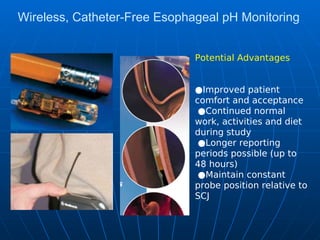 Wireless, Catheter-Free Esophageal pH Monitoring
Potential Advantages
●Improved patient
comfort and acceptance
●Continued normal
work, activities and diet
during study
●Longer reporting
periods possible (up to
48 hours)
●Maintain constant
probe position relative to
SCJ
 