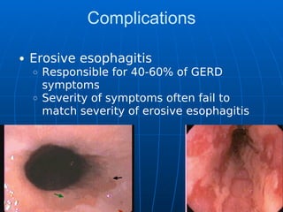Complications
Erosive esophagitis
Responsible for 40-60% of GERD
symptoms
Severity of symptoms often fail to
match severity of erosive esophagitis
 