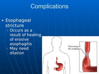 Complications
Esophageal
stricture
Occurs as a
result of healing
of erosive
esophagitis
May need
dilation
 