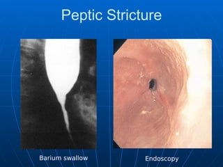Peptic Stricture
Barium swallow Endoscopy
 
