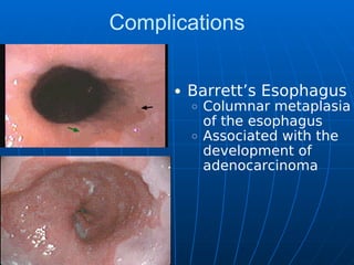 Complications
Barrett’s Esophagus
Columnar metaplasia
of the esophagus
Associated with the
development of
adenocarcinoma
 
