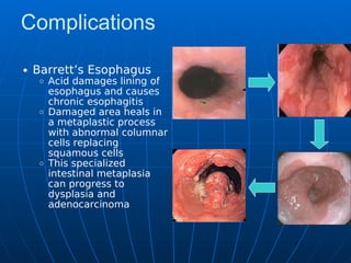 Complications
Barrett’s Esophagus
Acid damages lining of
esophagus and causes
chronic esophagitis
Damaged area heals in
a metaplastic process
with abnormal columnar
cells replacing
squamous cells
This specialized
intestinal metaplasia
can progress to
dysplasia and
adenocarcinoma
 
