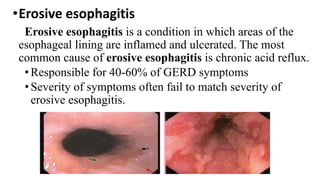 •Erosive esophagitis
Erosive esophagitis is a condition in which areas of the
esophageal lining are inflamed and ulcerated. The most
common cause of erosive esophagitis is chronic acid reflux.
•Responsible for 40-60% of GERD symptoms
•Severity of symptoms often fail to match severity of
erosive esophagitis.
 