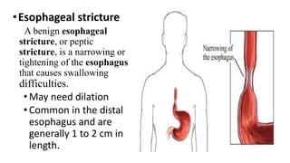 •Esophageal stricture
A benign esophageal
stricture, or peptic
stricture, is a narrowing or
tightening of the esophagus
that causes swallowing
difficulties.
•May need dilation
•Common in the distal
esophagus and are
generally 1 to 2 cm in
length.
 