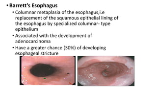 •Barrett’s Esophagus
• Columnar metaplasia of the esophagus,i.e
replacement of the squamous epithelial lining of
the esophagus by specialized columnar- type
epithelium
• Associated with the development of
adenocarcinoma
• Have a greater chance (30%) of developing
esophageal stricture
 