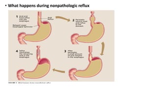 • What happens during nonpathologic reflux
 