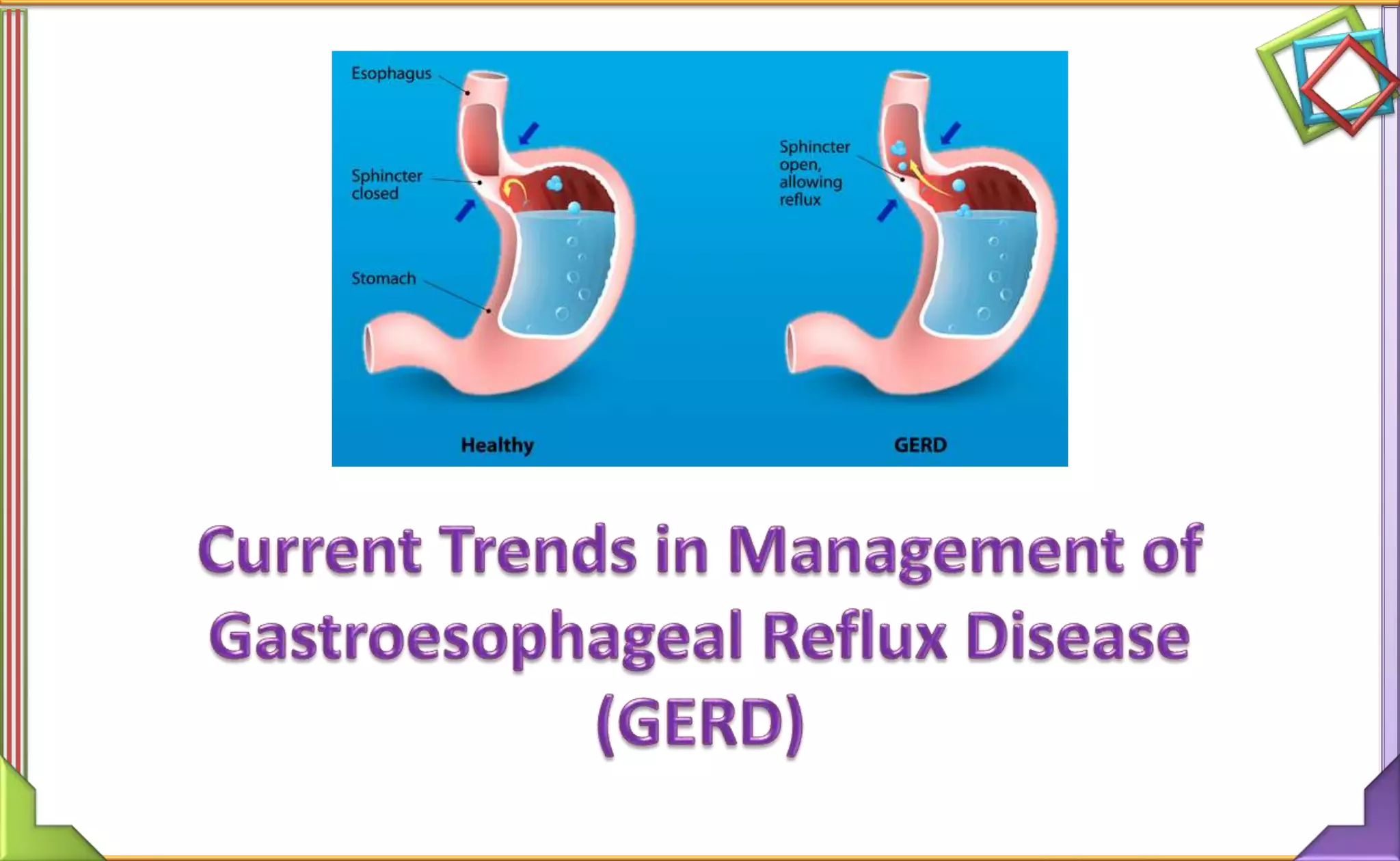 Current Trends in Management of Gastroesophageal Reflux Disease | PPTX