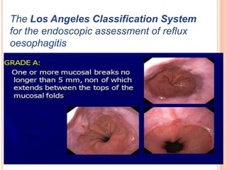 The Los Angeles Classification System 
for the endoscopic assessment of reflux 
oesophagitis 
 