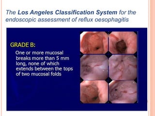 The Los Angeles Classification System for the 
endoscopic assessment of reflux oesophagitis 
 