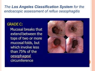 The Los Angeles Classification System for the 
endoscopic assessment of reflux oesophagitis 
 