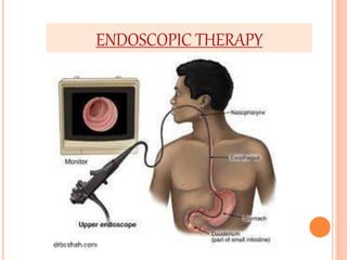 ENDOSCOPIC THERAPY 
 