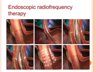 Endoscopic radiofrequency 
therapy 
 