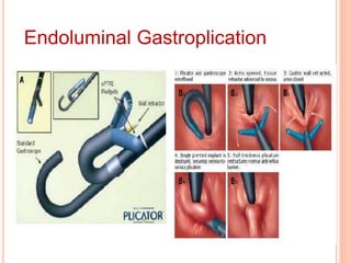 Endoluminal Gastroplication 
 