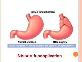 Nissen fundoplication 
 