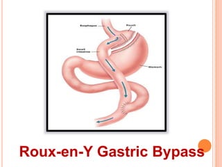 Roux-en-Y Gastric Bypass 
 