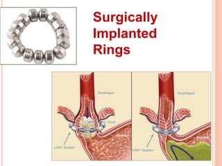 Surgically 
Implanted 
Rings 
 