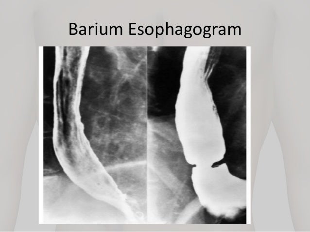 Gastroesophageal reflux and Hiatal Hernia