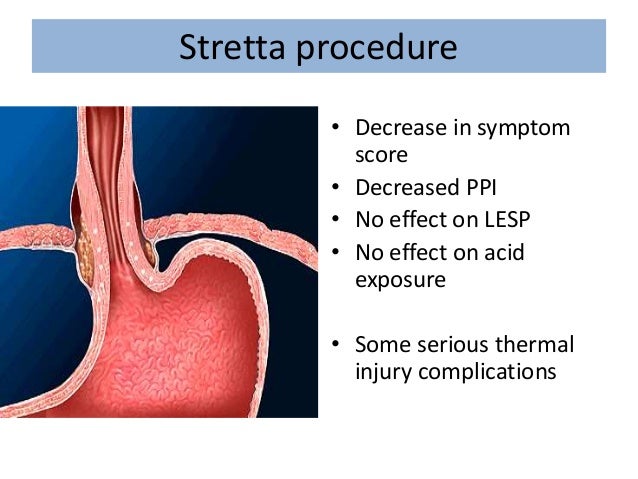 Gastroesophageal Reflux Disease