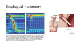 Manometry Reading Management of GERD.pptx