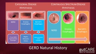 GERD Natural History
 