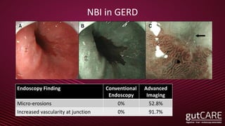 NBI in GERD
Endoscopy Finding Conventional
Endoscopy
Advanced
Imaging
Micro-erosions 0% 52.8%
Increased vascularity at junction 0% 91.7%
 