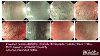 • Increased number, dilatation, tortuosity of intrapapillary capillary loops (IPCLs)
• Micro-erosions, increased vascularity
• Absence of round pit pattern
 