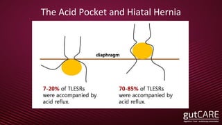 The Acid Pocket and Hiatal Hernia
 