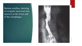 Barium swallow, showing
an irregular narrowed area
(arrows) at the lower end
of the oesophagus.
 