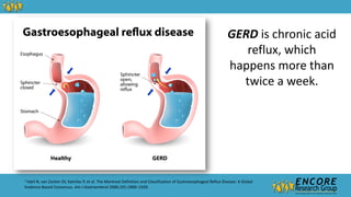 GERD is chronic acid
reflux, which
happens more than
twice a week.
1
Vakil N, van Zanten SV, Kahrilas P, et al. The Montreal Definition and Classification of Gastroesophageal Reflux Disease: A Global
Evidence-Based Consensus. Am J Gastroenterol 2006;101:1900–1920.
 