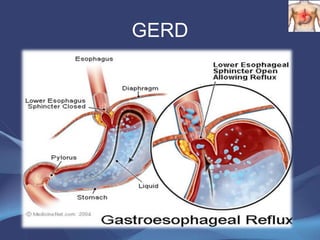 Gerd Path GERD,UNDERSTANDING | PPTX