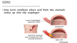 Gerd Rld Gerd ppt | PPTX
