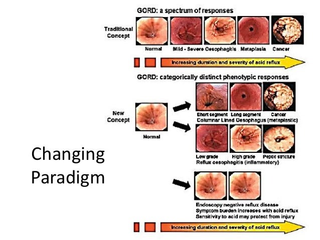 GERD: Telling Fact from Fiction